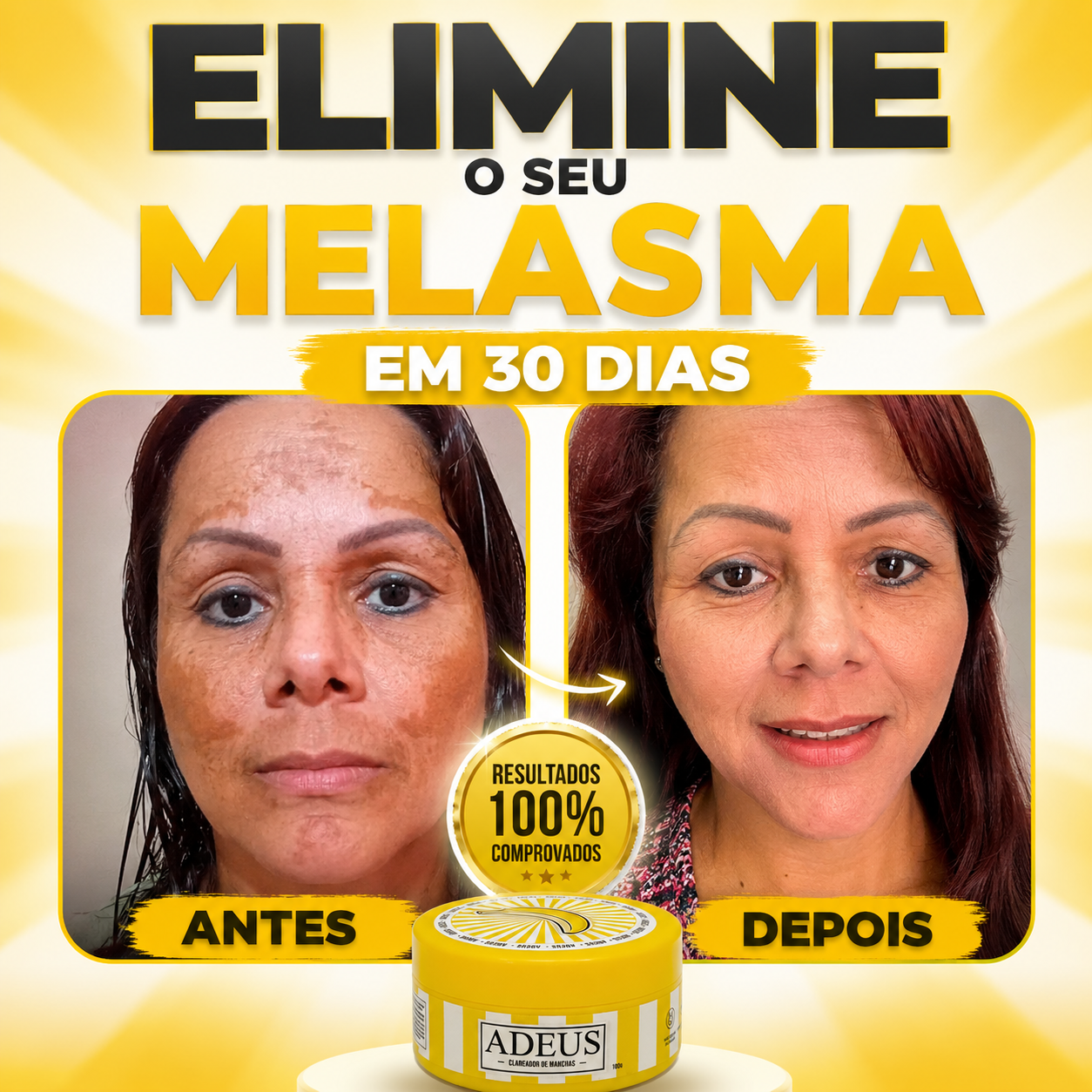 Elimine o seu melasma em 30 dias com o Clareador ADEUS