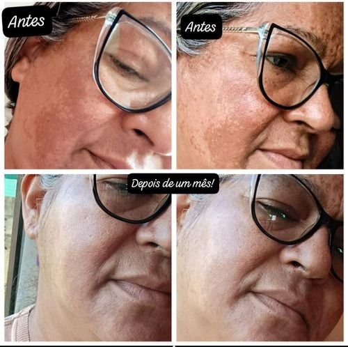 Antes e depois de Marlene S. usando o Clareador ADEUS